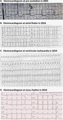 Case Report: Multiple types of arrhythmias in a late-confirmed Danon disease